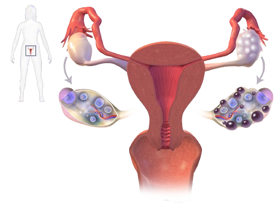 Polycystic Ovary Syndrome (PCOS)