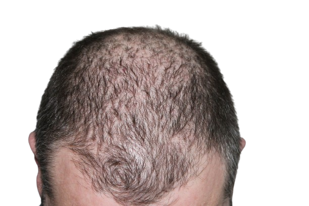 Going bald or Hair Development