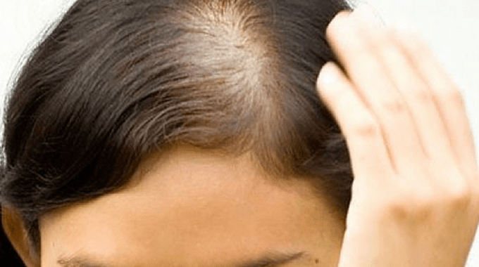 PCOS Hair Loss: Causes, Treatment, and Management